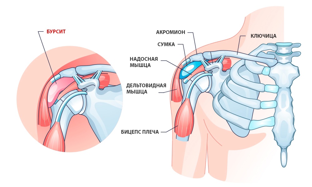 Субкоракоидальная сумка плечевого сустава. Dislocated shoulder blade. Сумка плеча болит. Сумка плеча болит. Shoulder.